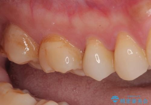 オールセラミッククラウンによる奥歯のむし歯治療の治療前