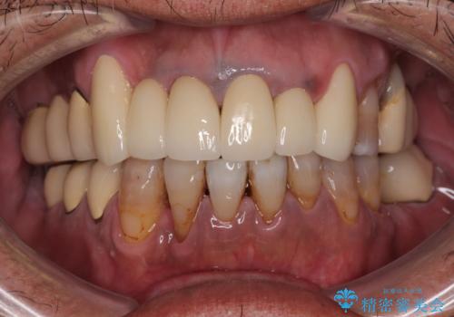 仮歯が汚くて転院 前歯のオールセラミッククラウン治療の治療後