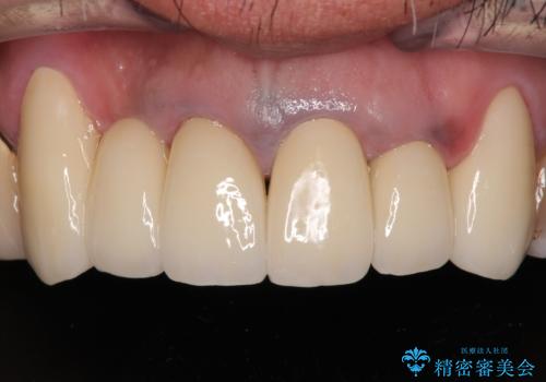 仮歯が汚くて転院 前歯のオールセラミッククラウン治療の症例 治療後