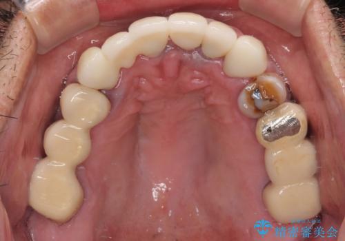 仮歯が汚くて転院 前歯のオールセラミッククラウン治療の治療後