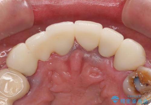 仮歯が汚くて転院 前歯のオールセラミッククラウン治療の治療後