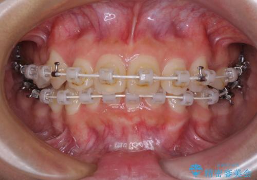 唇を閉じてもはみ出してしまう上顎前歯　抜歯矯正で口元を改善の治療中