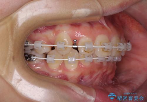 唇を閉じてもはみ出してしまう上顎前歯　抜歯矯正で口元を改善の治療中