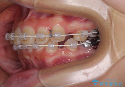 唇を閉じてもはみ出してしまう上顎前歯　抜歯矯正で口元を改善の治療中