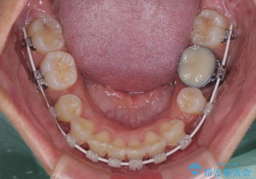 唇を閉じてもはみ出してしまう上顎前歯　抜歯矯正で口元を改善の治療中