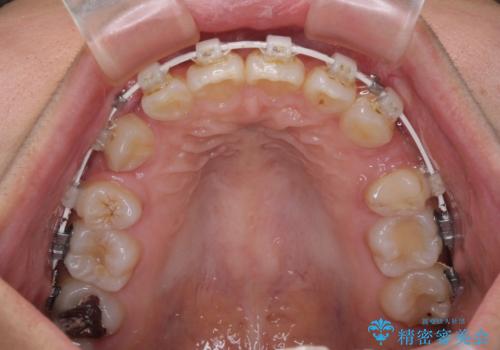唇を閉じてもはみ出してしまう上顎前歯　抜歯矯正で口元を改善の治療中