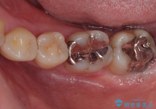 銀歯が目立つのでやり替えたい セラミックインレー修復の症例 治療前