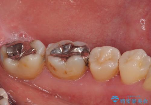 銀歯が目立つのでやり替えたい　セラミックインレー修復の治療前