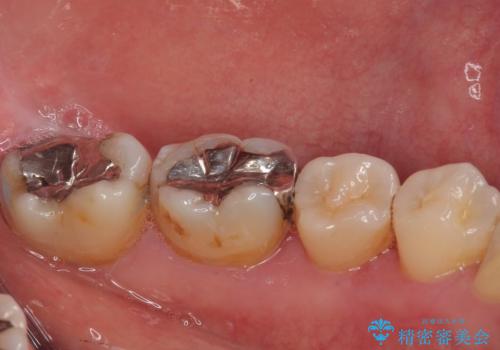 銀歯が目立つのでやり替えたい セラミックインレー修復の治療前