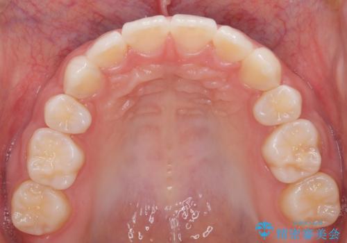 【審美装置】歯を抜いてEラインをきれいにの治療後