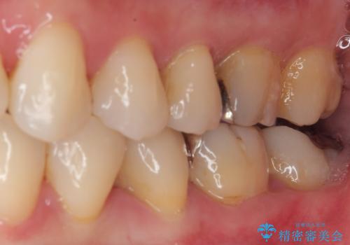 銀歯が目立つのでやり替えたい セラミックインレー修復の治療前