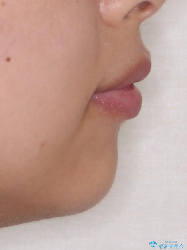 口元が出ているのを改善したい。 クリアブラケットによる抜歯矯正の治療前(顔貌)