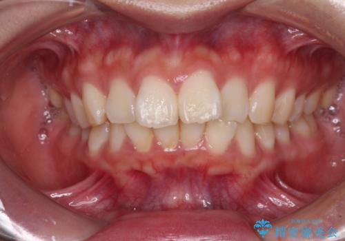 口元が出ているのを改善したい。 クリアブラケットによる抜歯矯正の症例 治療前