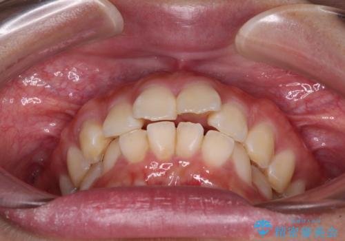 口元が出ているのを改善したい。 クリアブラケットによる抜歯矯正の治療前