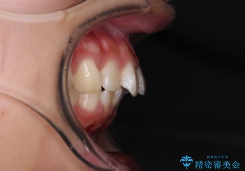 口元が出ているのを改善したい。 クリアブラケットによる抜歯矯正の治療前