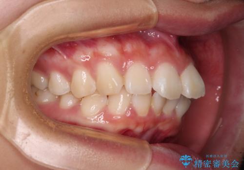 口元が出ているのを改善したい。 クリアブラケットによる抜歯矯正の治療前