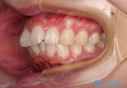 口元が出ているのを改善したい。 クリアブラケットによる抜歯矯正の治療前