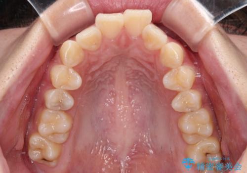 口元が出ているのを改善したい。 クリアブラケットによる抜歯矯正の治療前