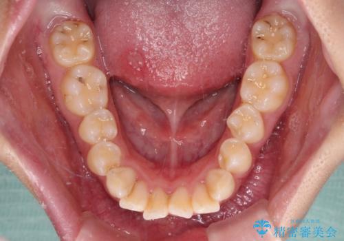 口元が出ているのを改善したい。 クリアブラケットによる抜歯矯正の治療前