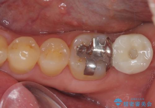 外側に飛び出している歯　部分矯正を用いた奥歯の補綴治療の症例 治療後