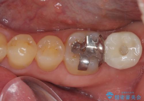 外側に飛び出している歯 部分矯正を用いた奥歯の補綴治療