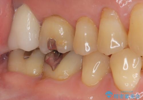 外側に飛び出している歯 部分矯正を用いた奥歯の補綴治療の治療後
