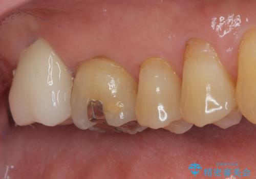 外側に飛び出している歯 部分矯正を用いた奥歯の補綴治療の治療後