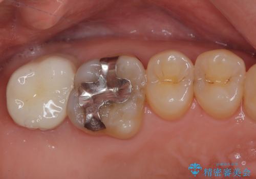 外側に飛び出している歯 部分矯正を用いた奥歯の補綴治療の治療後