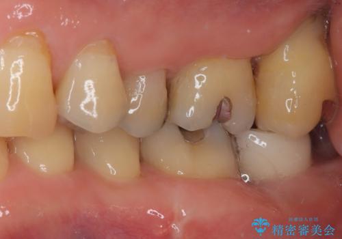 外側に飛び出している歯 部分矯正を用いた奥歯の補綴治療の治療後