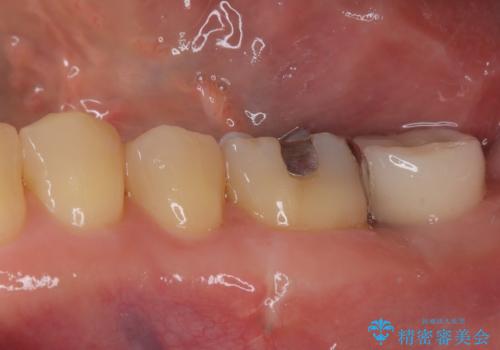 外側に飛び出している歯 部分矯正を用いた奥歯の補綴治療の治療後
