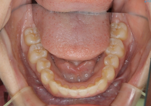 どこで噛んだらいいのかわからない:ワイヤーによる矯正治療の治療後