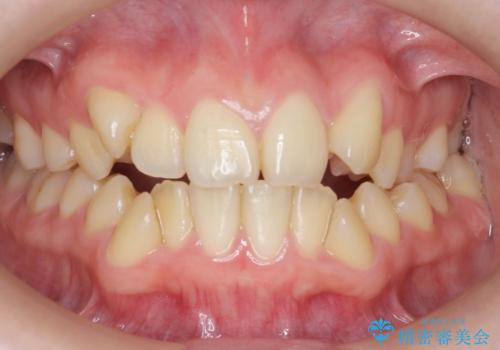 歯並びのせいで歯ブラシがしづらい マルチブラケットを用いた抜歯矯正の症例 治療前