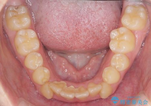 歯並びのせいで歯ブラシがしづらい マルチブラケットを用いた抜歯矯正の治療前