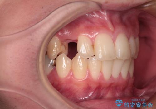 歯が生えてこない インプラントによる補綴治療の症例 治療前