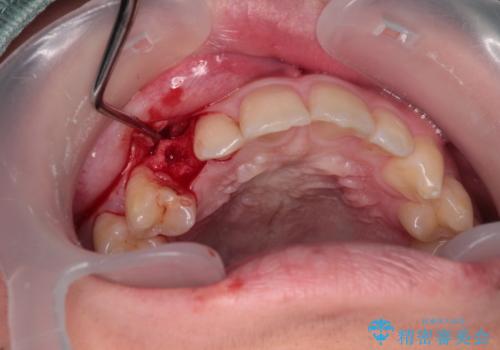 歯が生えてこない インプラントによる補綴治療の治療前