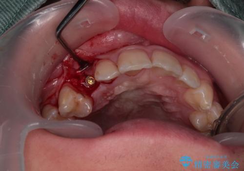 歯が生えてこない　インプラントによる補綴治療の治療中