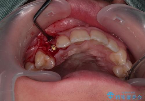 歯が生えてこない インプラントによる補綴治療の治療中