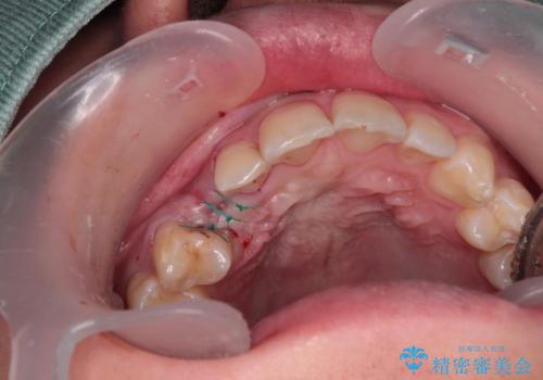 歯が生えてこない インプラントによる補綴治療の治療後