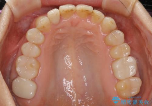 審美性と機能を改善! インビザライン矯正の治療後