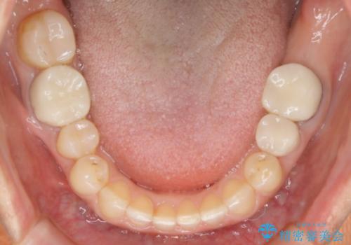 審美性と機能を改善! インビザライン矯正の治療後