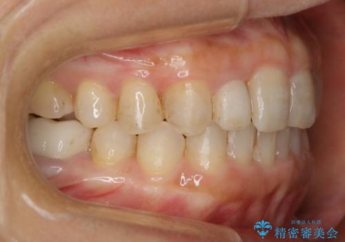 審美性と機能を改善! インビザライン矯正の治療後