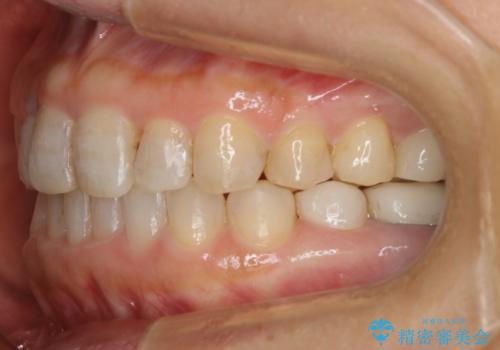 審美性と機能を改善! インビザライン矯正の治療後