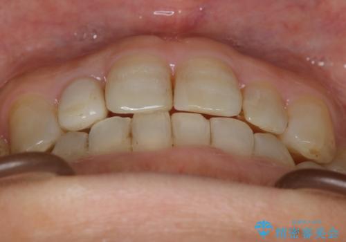 審美性と機能を改善! インビザライン矯正の治療後