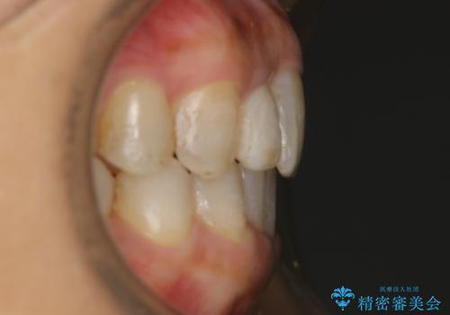 審美性と機能を改善! インビザライン矯正の治療後