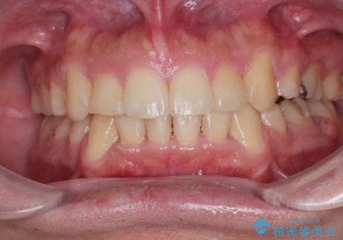 デコボコと口元の突出感を改善 抜歯矯正治療