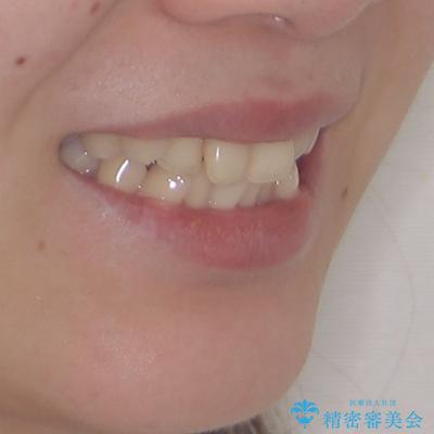 前歯のデコボコを抜歯矯正でスッキリした口元にの治療前(顔貌)