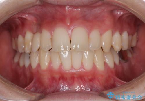 歯が生えてこない インプラントによる補綴治療の治療後