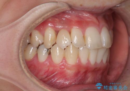 歯が生えてこない インプラントによる補綴治療の症例 治療後