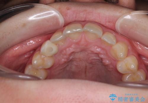 歯が生えてこない インプラントによる補綴治療の治療後