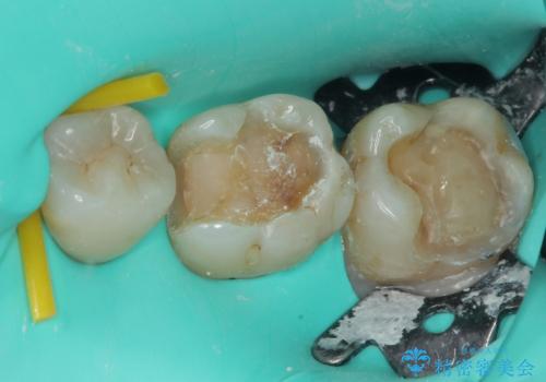 銀歯が目立つのでやり替えたい セラミックインレー修復の治療中